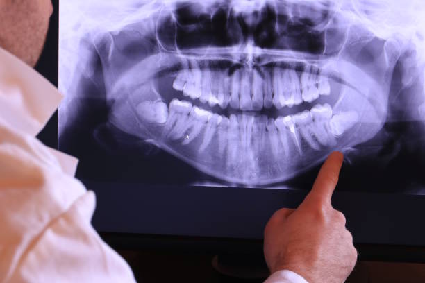Best Emergency Wisdom Teeth Removal in Dousman, WI